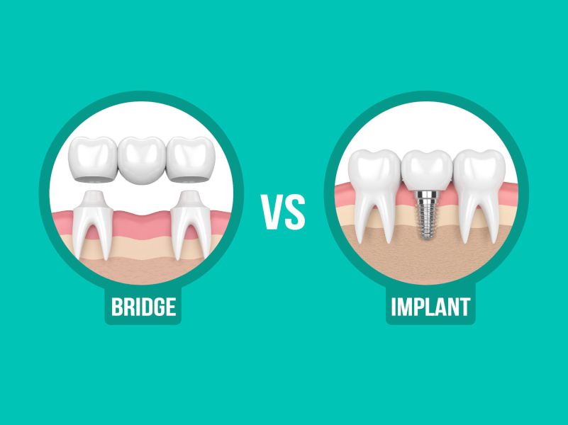 Dental Implants vs Crown and Bridge: Which is better?