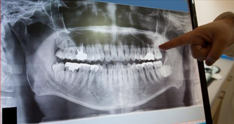 Dental X-Rays Are Safe