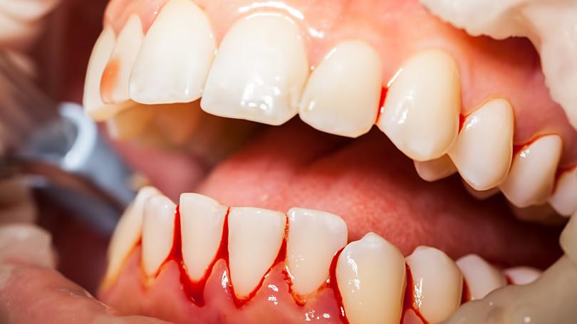 Bleeding Gums: Causes, Prevention and Treatment