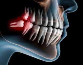 WISDOM TOOTH / IMPACTED TOOTH REMOVAL