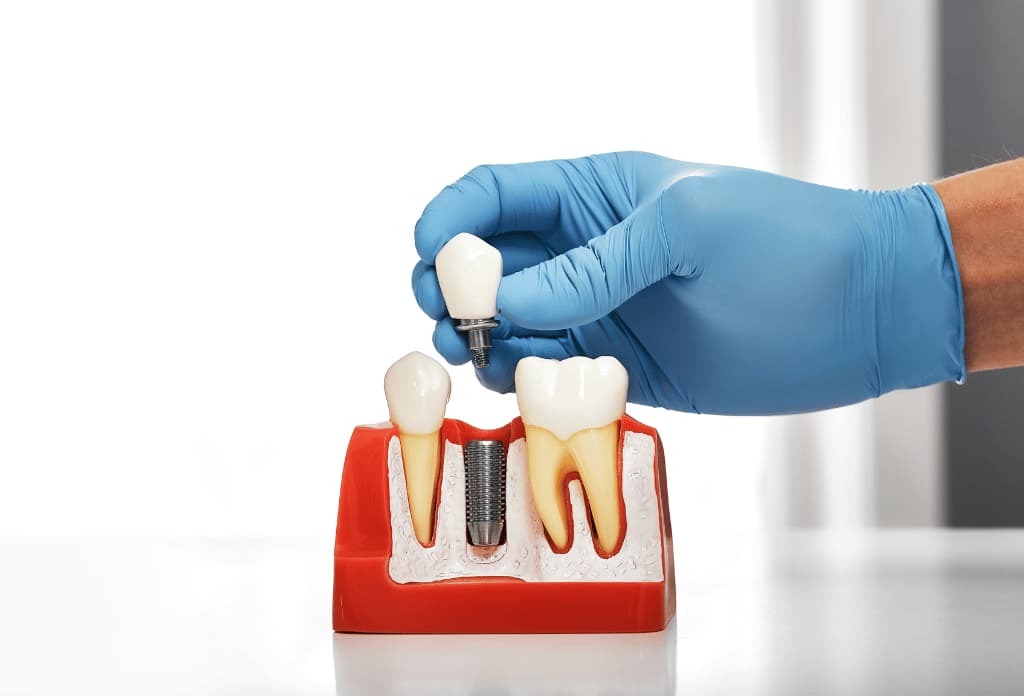 Exploring Different Types of Dental Implants: Which One Is Right for You?