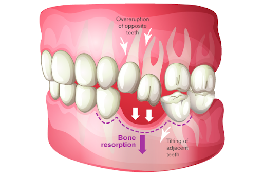 Why replace missing teeth?